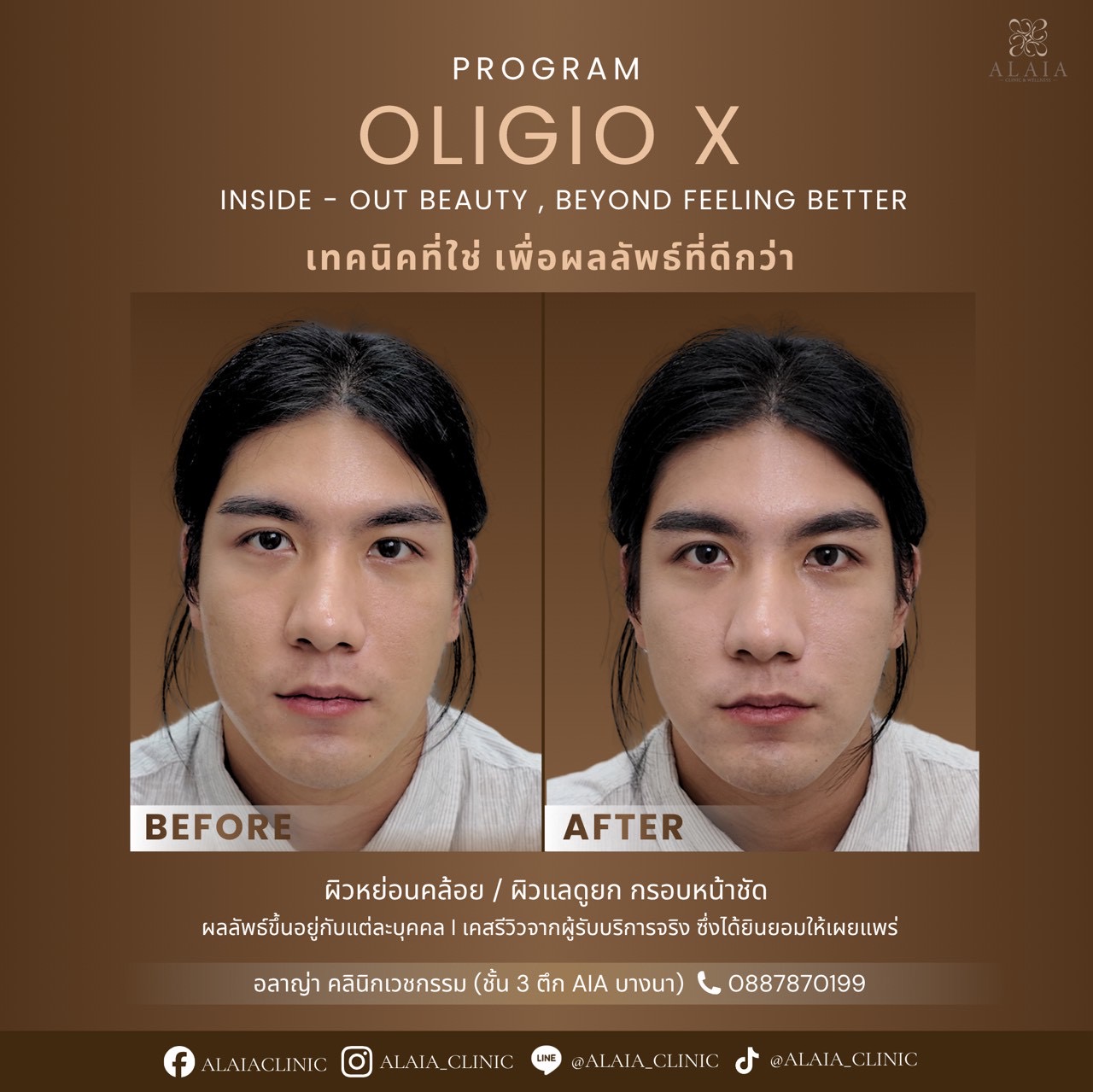 Oligio X Real Result 1